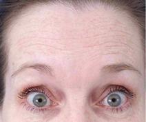 Botulinum toxin Before